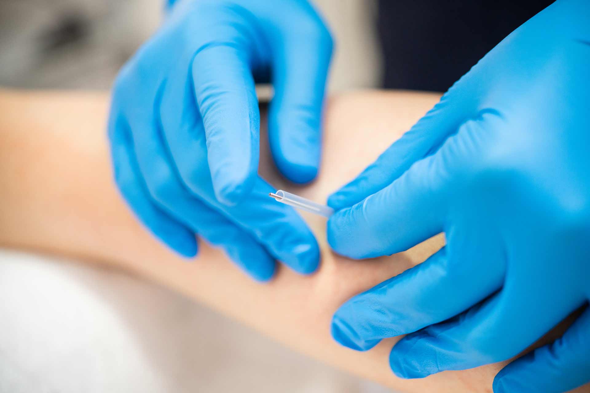 Dry Needling is available at MKE Physical Therapy in Milwaukee, Wisconsin